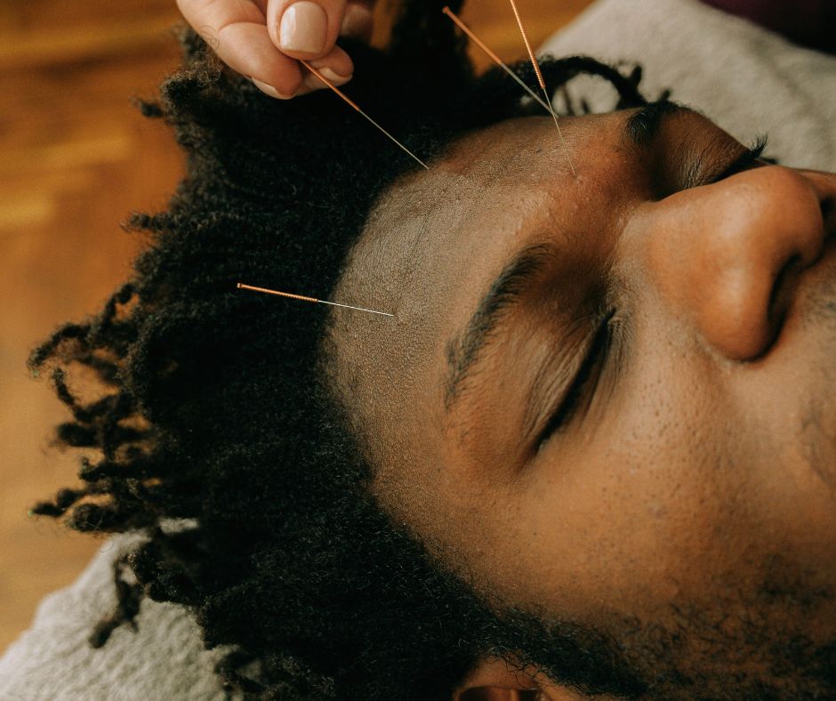 Acupuncture young man frontal